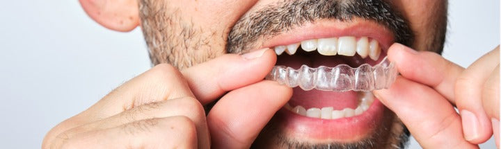 How Long Do Retainers Need to Be Worn? A Detailed Overview